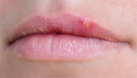 Red Bumps On Lips Treatment Theplamen Blog