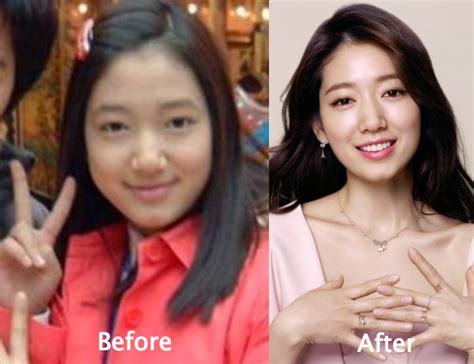 Park Shin Hye Plastic Surgery Before And After Photos