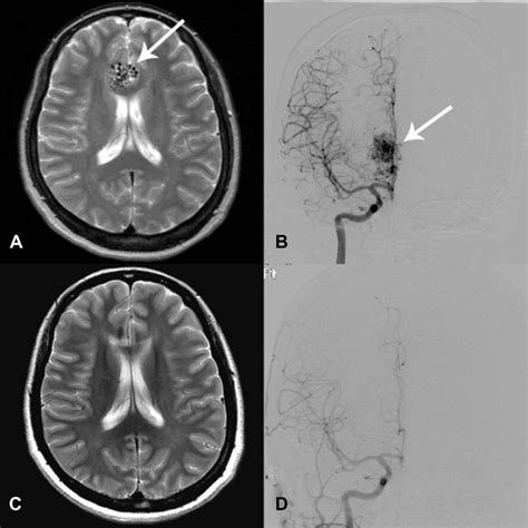 A Magnetic Resonance Imaging Showed An Arteriovenous Malformation