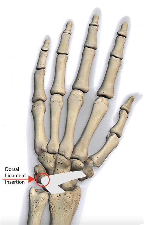 Avulsion Fractures Of The Triquetrum Fife Virtual Hand Clinic