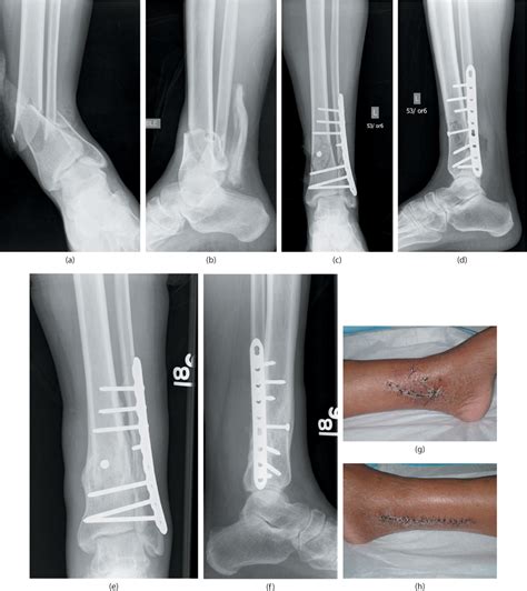 External Fixation Of Distal Tibial Fractures Musculoskeletal Key Images