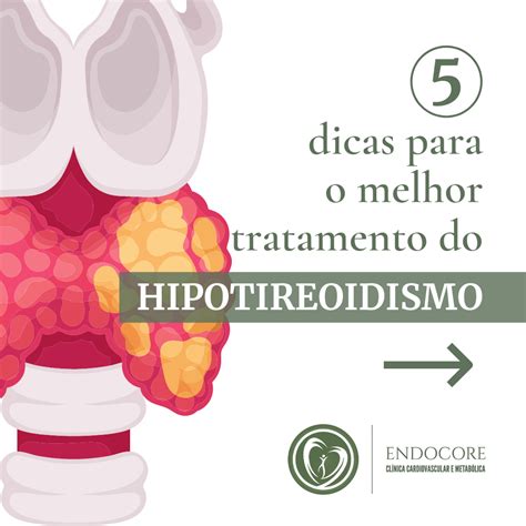 Dicas Para O Melhor Tratamento Do Hipotireoidismo Endocore
