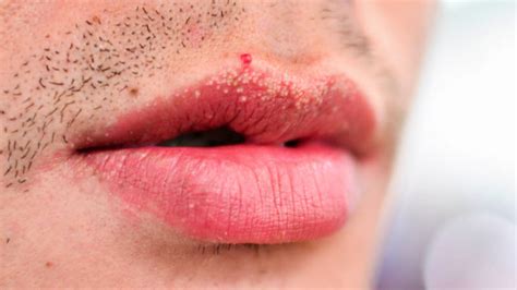 Почему возникают гранулы Фордайса на губах и как от них избавиться