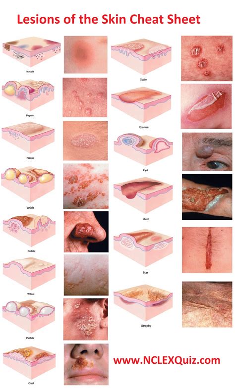 Types Of Skin Lesions Benign Skin Lesions Plastic Surgery Key Images