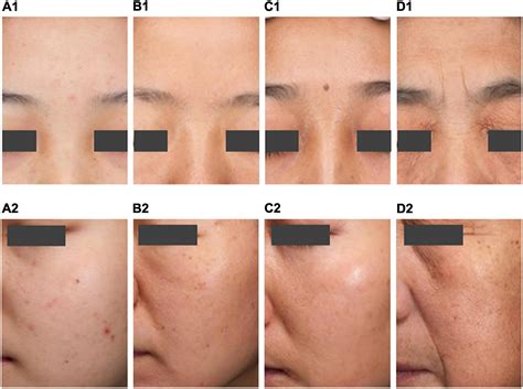 Frontiers Facial Skin Aging Stages In Chinese Females