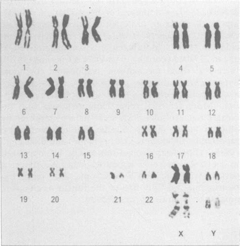 Chromosome Analysis Of The Patient Showing Non Mosaic 48 Xxyy Download Scientific Diagram