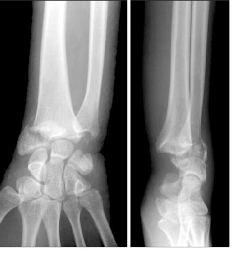 Figure 1 From Ulnar Nerve Palsy Following Closed Fracture Of The Distal