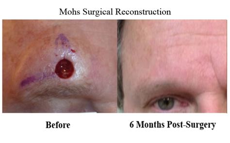 Mohs Surgery Maryland Md Dermatology Mohs Surgery Cosmetic Surgical