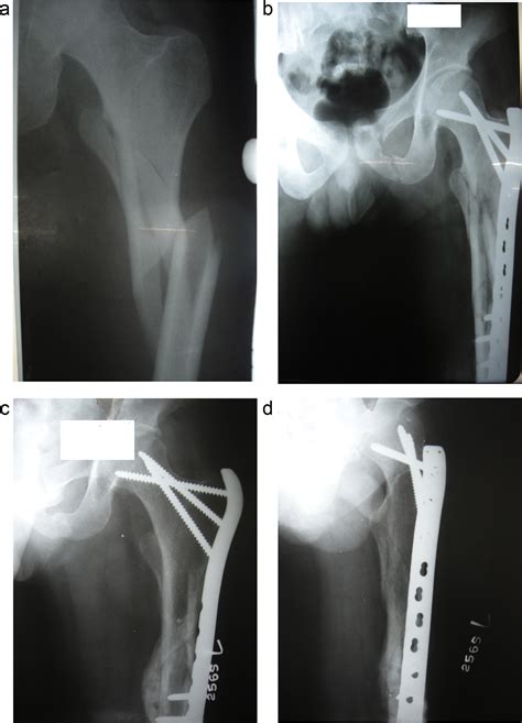 Biological Fixation Of Comminuted Subtrochanteric Fractures With