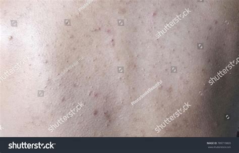 Pimple On Back Stock Photo 789719869 Shutterstock