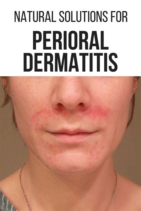Perioral Dermatitis Your Ultimate Guide To Long Term Healing Dry