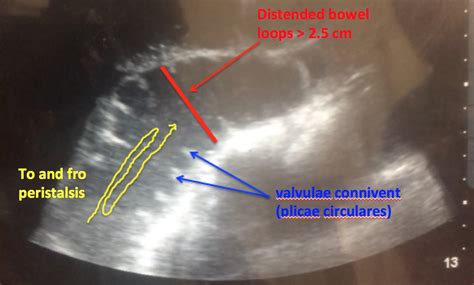 Ultrasound 9 Small Bowel Obstruction Emhum