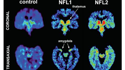 New Study Reveals That Cte May Be Detectable In Living Patients