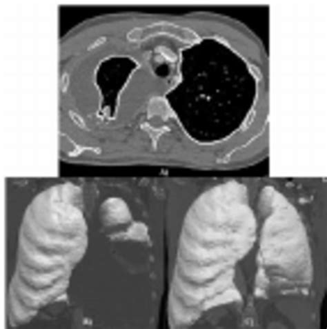 Lung parenchyma is the medical term used to describe the actual functioning parts of a human or animal lung. Segmented lung parenchyma. (A) Axial CT section with lung parenchyma... | Download Scientific ...