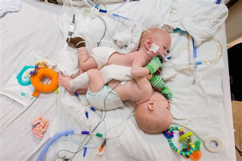 5 Amazing Stories Of Conjoined Twins That Were Successfully Separated Ratemds Health News
