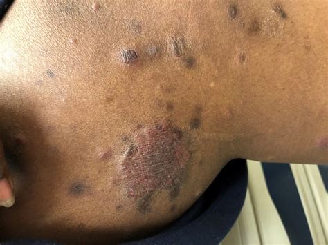 Itchy Scaly Rash On The Back Dermatology Advisor