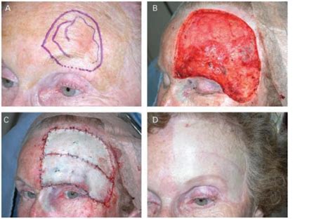 Acceptance Of Residual Melanoma In Situ Avoiding Cosmetic And