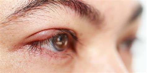 Can You Get Pimples On Eyelids How To Spot And Treat A Stye