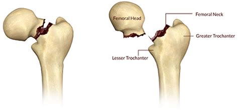 It is important to try to relocate in this situation, open reduction is required, meaning that an orthopedic surgeon has to operate to remove any foreign objects in the joint and then reduce. Hip Joint Fracture|Classification|Types|Causes|Symptoms ...