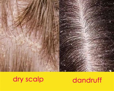What Is Dandruff Differences Between Dandruff Vs Dry Scalp My Xxx Hot