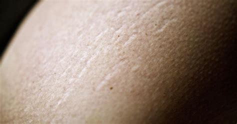 Pimples On Stretch Marks Livestrongcom
