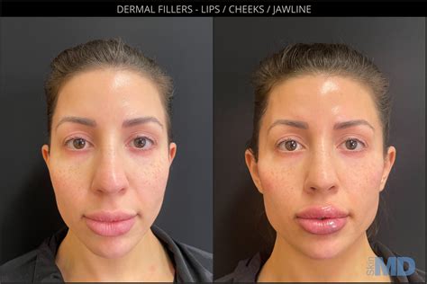 Dermal Fillers Boston Skin MD Laser Cosmetic Group