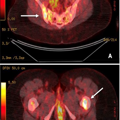 Fused Petct Axial Images Of Pelvis At The Levels Of The Sacroiliac