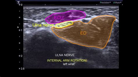 Ultrasound Ulna Nerve Entrapment Wrist Youtube