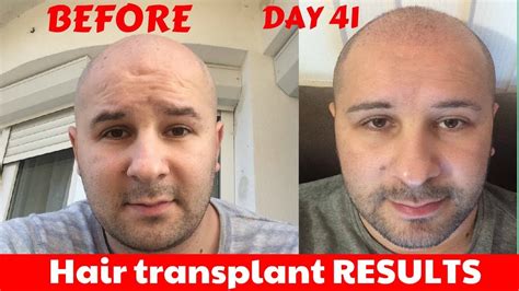 FUE Hair Transplant Before And After Results DAY 41 WEEK 6