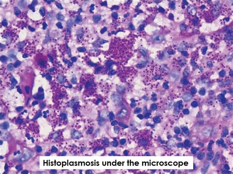 Histoplasmosis What You Need To Know Bird Deterrent Specialists