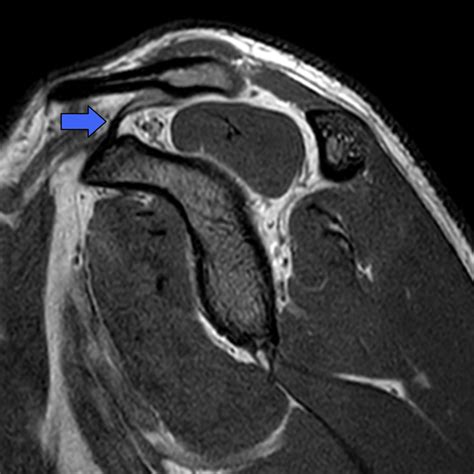Pectoralis Major Muscle Radiology Reference Article
