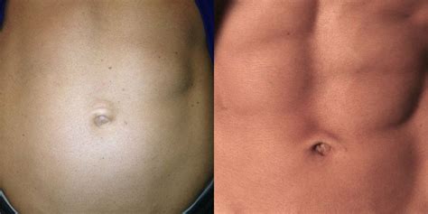 Knowledge of these hernias (usual and unusual) and of protrusions that mimic them is an essential component of the armamentarium of the general and pediatric surgeon. NJ Hernia Repair | New Jersey Best Plastic Surgeons ...