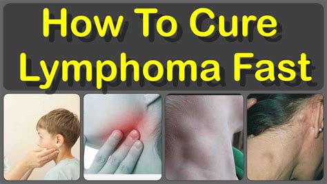 What Is Lymphoma And How To Cure Lymphoma With Home Remedies Lymphoma