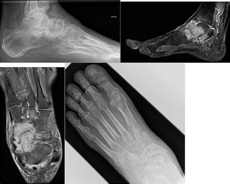 Radiographs And Mri Of Talonavicular Joint Tb With Erosions On Talar
