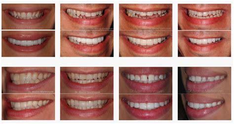 What Veneers Do With Before And After Pictures Included Pacific