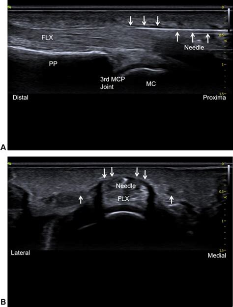 A Ultrasound Guided Percutaneous A1 Pulley Release By Acupotomy