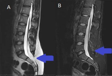 Cureus Tethered Cord Syndrome Associated With Lumbar