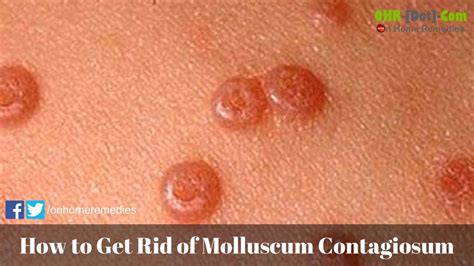 How To Get Rid Of Molluscum Contagiosum Youtube