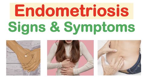 Endometriosis Signs Symptoms Why They Occur Youtube