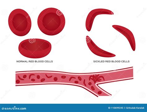 Normal Red Blood Cell And Sickle Cell Stock Vector Illustration Of