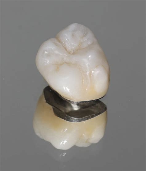 What Is A Porcelain Fused To Metal Crown