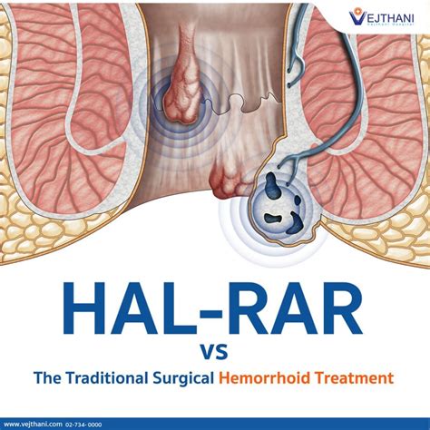 The Difference Between HAL RAR And The Traditional Surgical Hemorrhoid