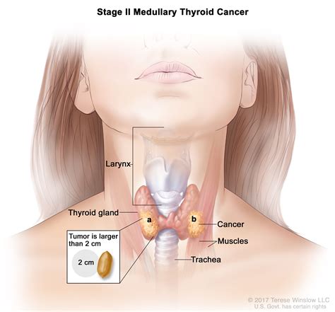 Thyroid Cancer UCSF Department Of Surgery