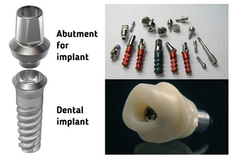 Abutments For Implants Implant Centre Martinko