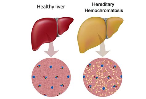 Hemochromatosissymptomscausestreatment And Diet How To Relief