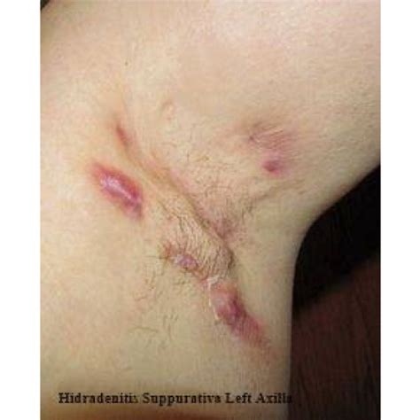 Sweat Gland Infection Armpit