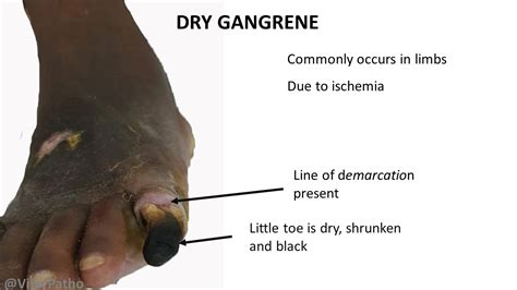 Pathology Of Gangrene Pathology Made Simple