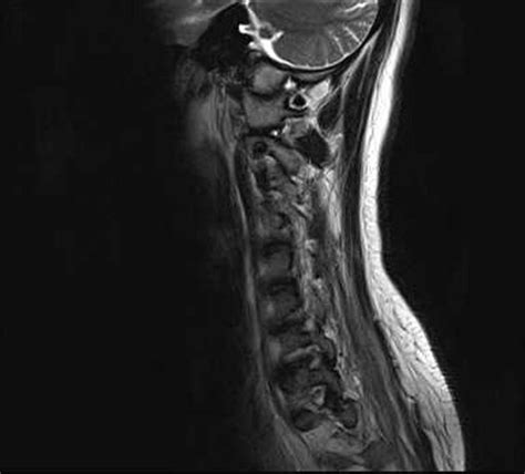 Transverse implies that the inflammation extends horizontally across the spinal cord. Sequelae of transverse myelitis | Radiology Case ...