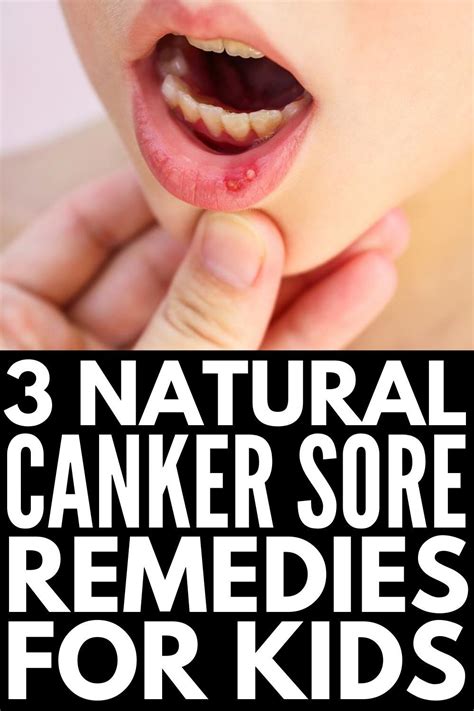 Natural And Effective 9 Canker Sore Remedies That Work Fast Canker Sore Canker Sore Remedy