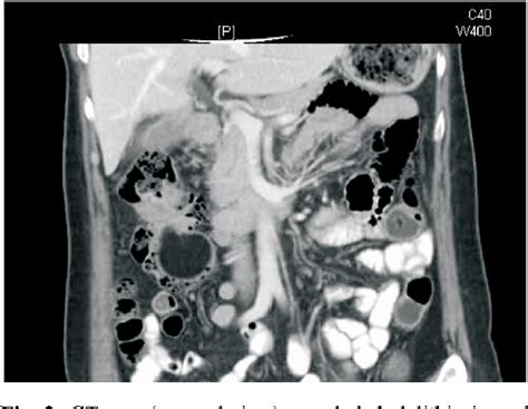 Figure 2 From A Colonic Submucosal Giant Lipoma Presenting With